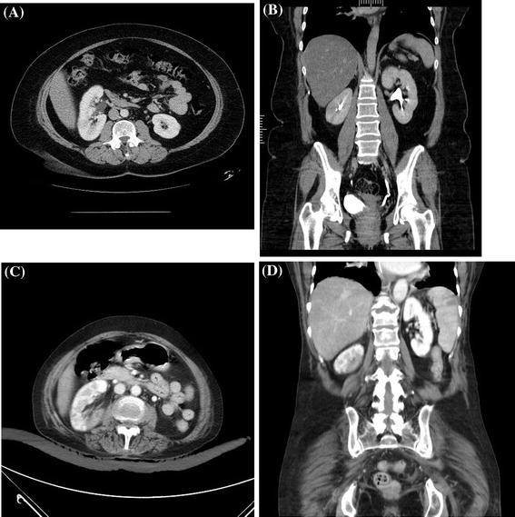 Figure 2 Sagittally Malrotated Kidney A Case Series Of Two Patients Springerlink