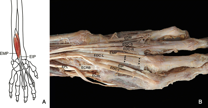 Figure 2 Extensor Tendons And Variations Of The Medial Four Digits Of Hand A Cadaveric Study Springerlink