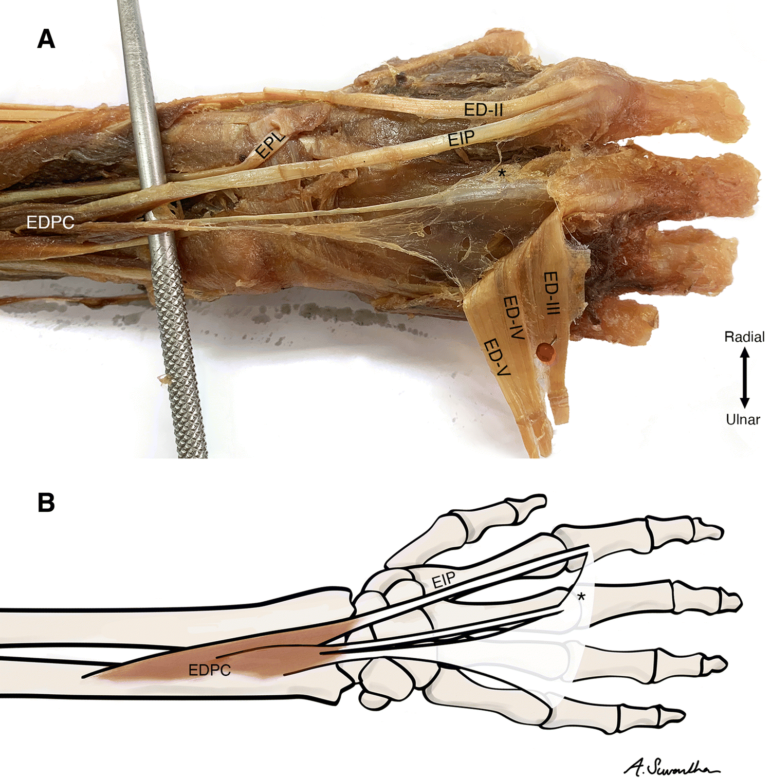 Figure 1 Complete Extensor Digitorum Profundus Complex A Deep Hand Extensor Muscle To The Medial Four Digits Springerlink