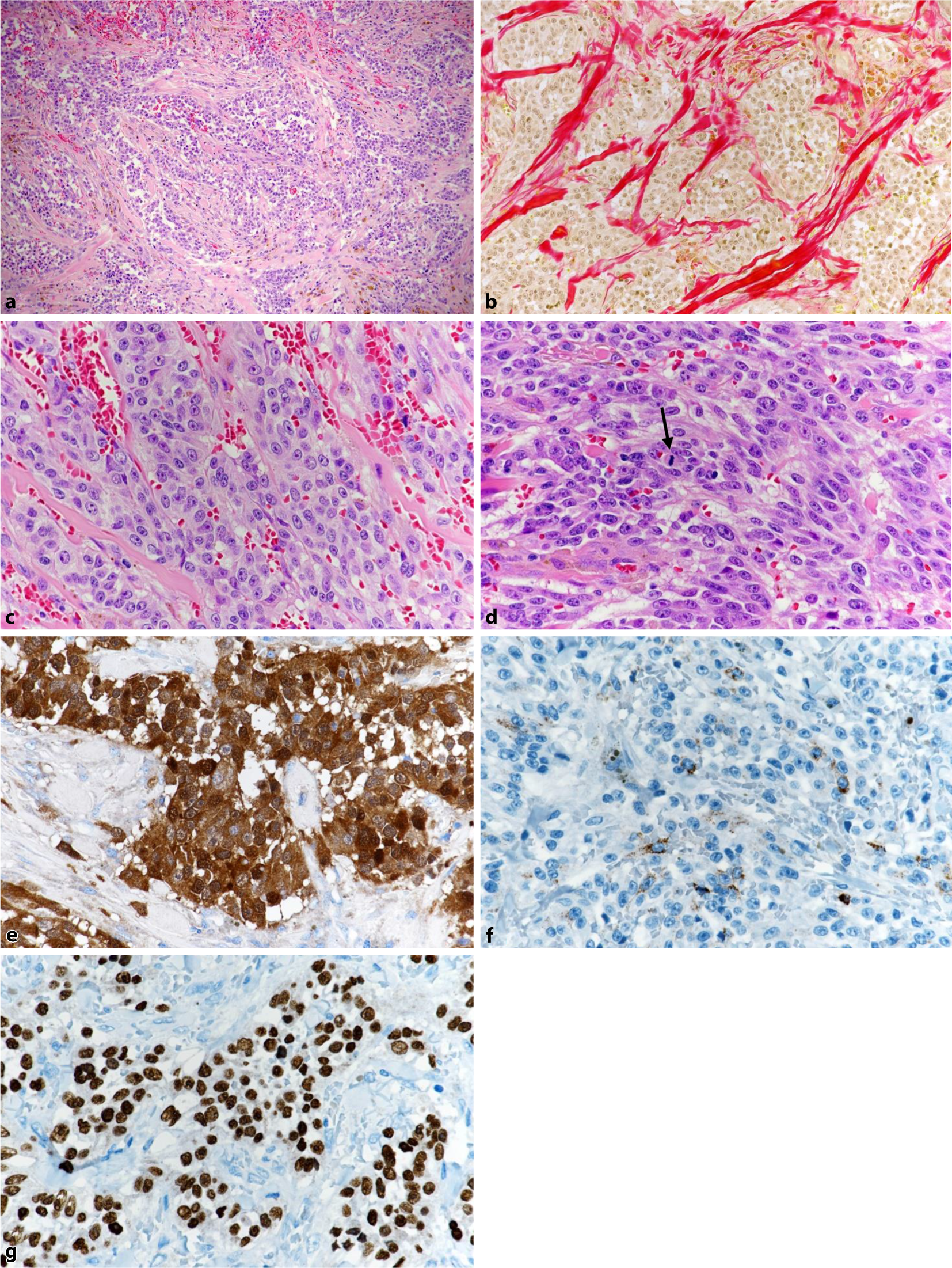 Figure 5 Epitheloide Biphasische Und Mischtumoren Des Weichgewebes Springerlink