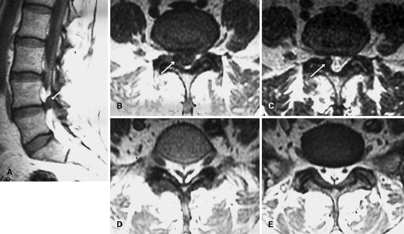 Figure 6 | Lumbosacral epidural lipomatosis: MRI grading | SpringerLink