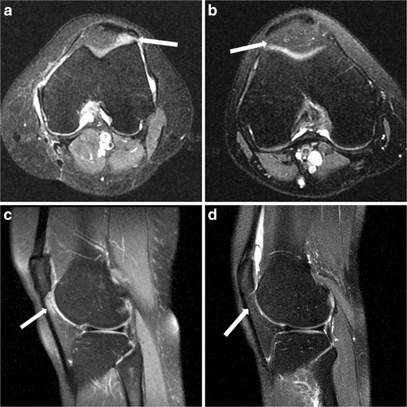 Figure 1 | Sharp margin of antero-inferior lateral femoral condyle as a  risk factor for patellar tendon-lateral femoral condyle friction syndrome |  SpringerLink