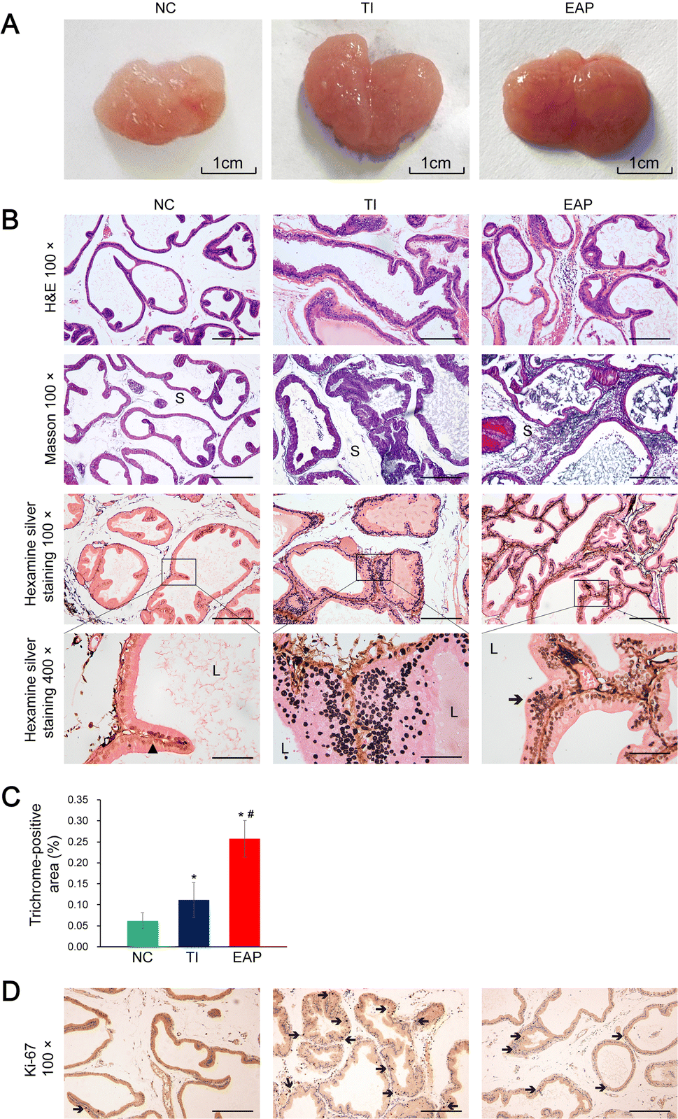 prostate hyperplasia 1 art