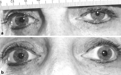 Figure 3 | Efferente Pupillenstörungen | SpringerLink
