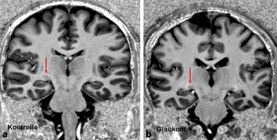 Figure 17 Diffusionsbildgebung Der Sehbahn Bei Glaukomatoser Optikusatrophie Springerlink