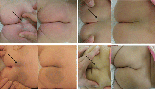 wallpapers Different Types Of Dimples figure 2 sacrococcygeal dimple new