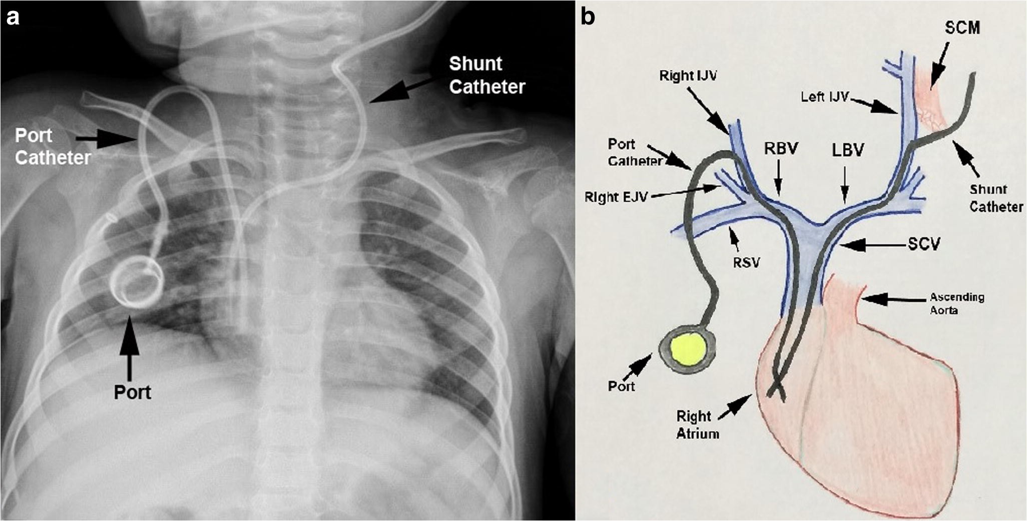 Figure 3 Port A Cath And Ventriculoatrial Shunt At The Same Atrium Technical Note Springerlink