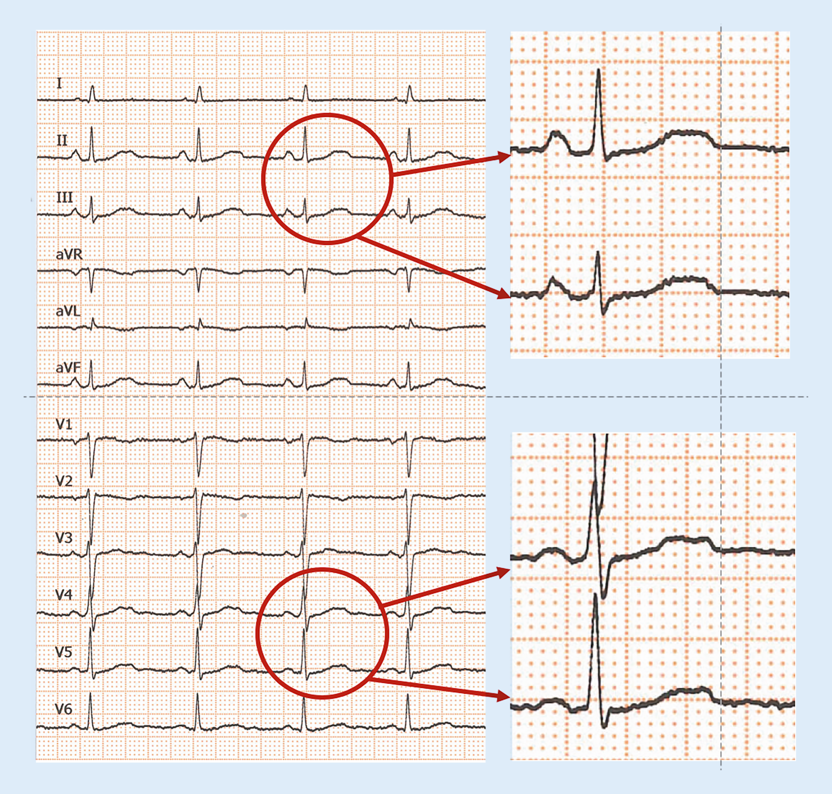 Figure Kanalopathien Arrhythmogene Rechtsventrikulare Kardiomyopathie Und Artefakte Springerlink