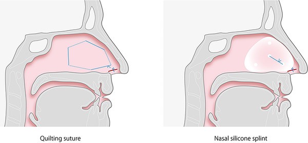 photo Septoplasty Nasal Splints figure 2 nasal silicone splints and