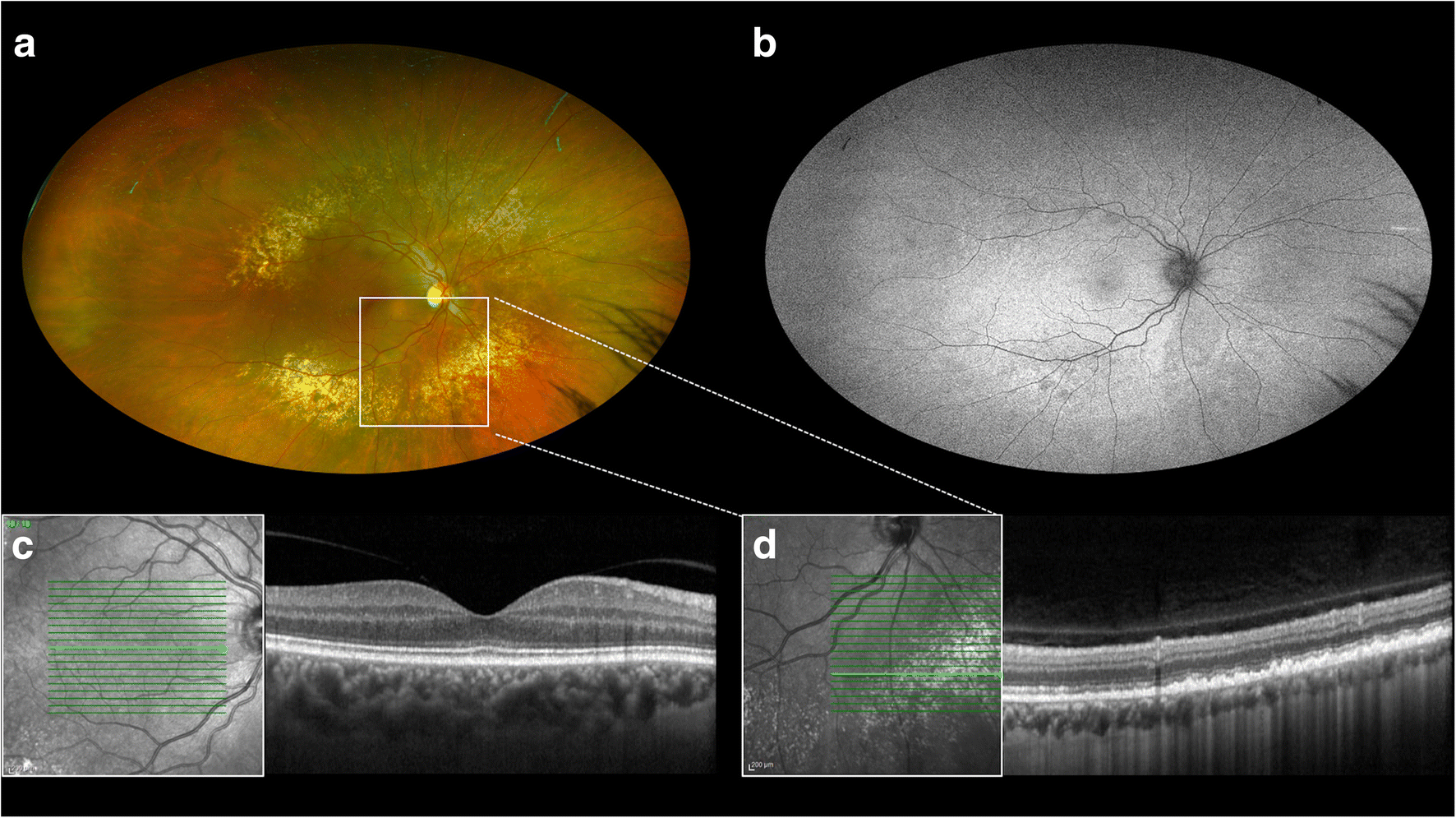 Figure 3 Multimodal Imaging Characterization Of Peripheral Drusen Springerlink