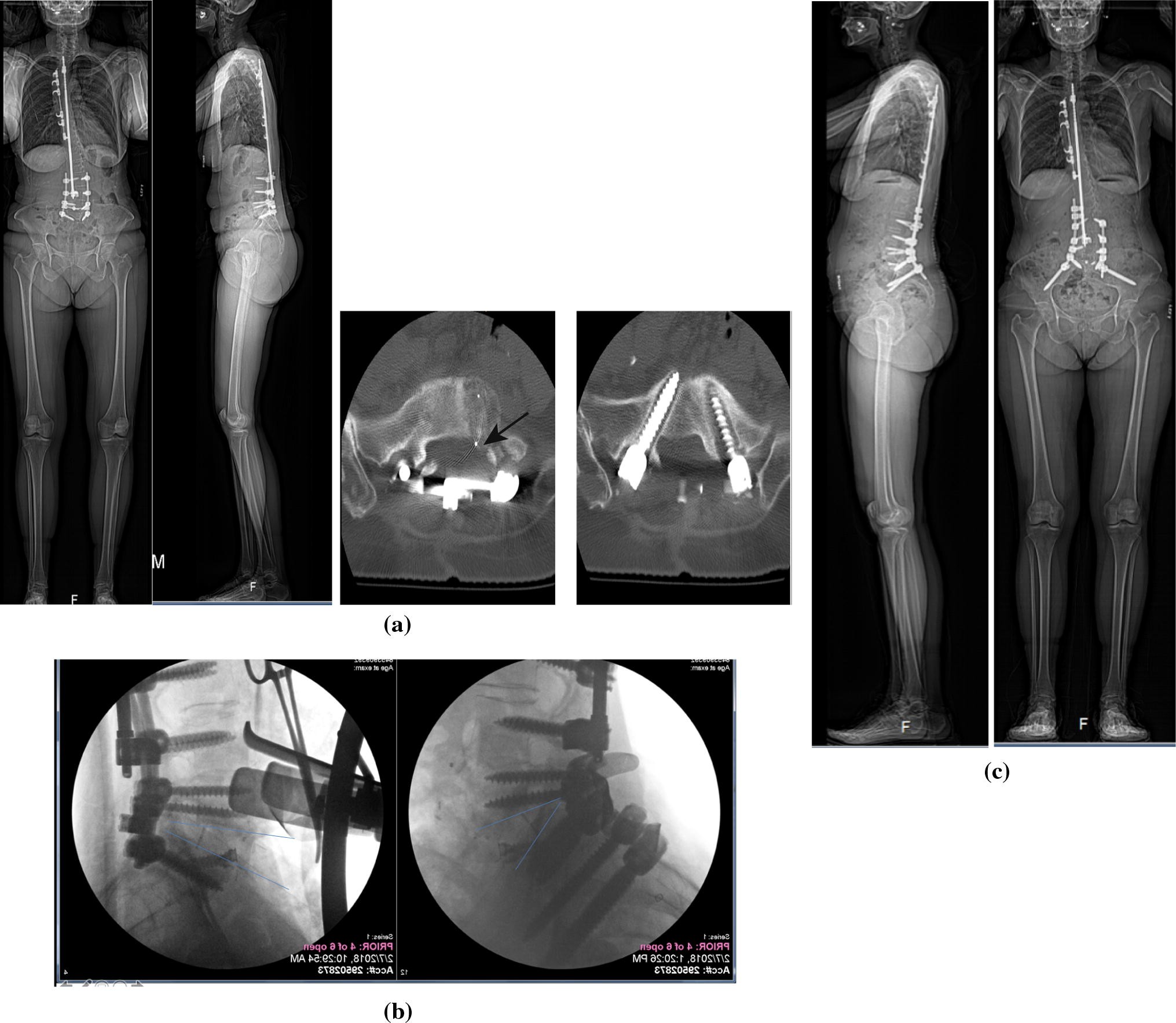 Figure 5 | Revision surgery for non-union in adult spinal deformity |  SpringerLink