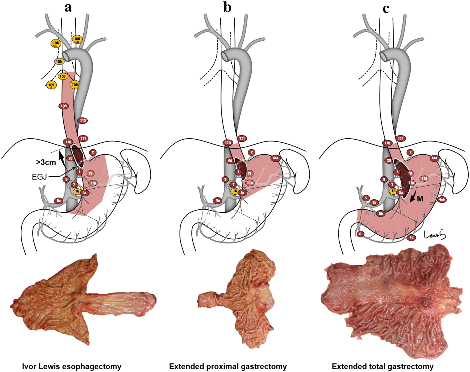 Figure 3 True Esophagogastric Junction Adenocarcinoma Background Of Its Definition And Current Surgical Trends Springerlink Figure 3 True Esophagogastric Junction Adenocarcinoma Background Of Its Definition And Current Surgical Trends Springerlink