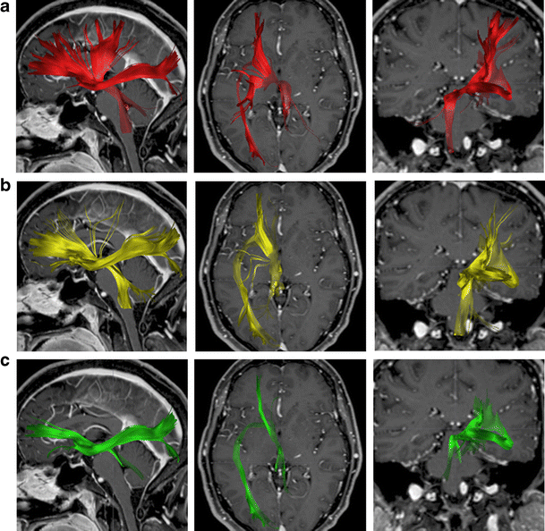 Figure 2 Dti Based Deterministic Fibre Tracking Of The Medial Forebrain Bundle Springerlink Figure 2 Dti Based Deterministic Fibre Tracking Of The Medial Forebrain Bundle Springerlink