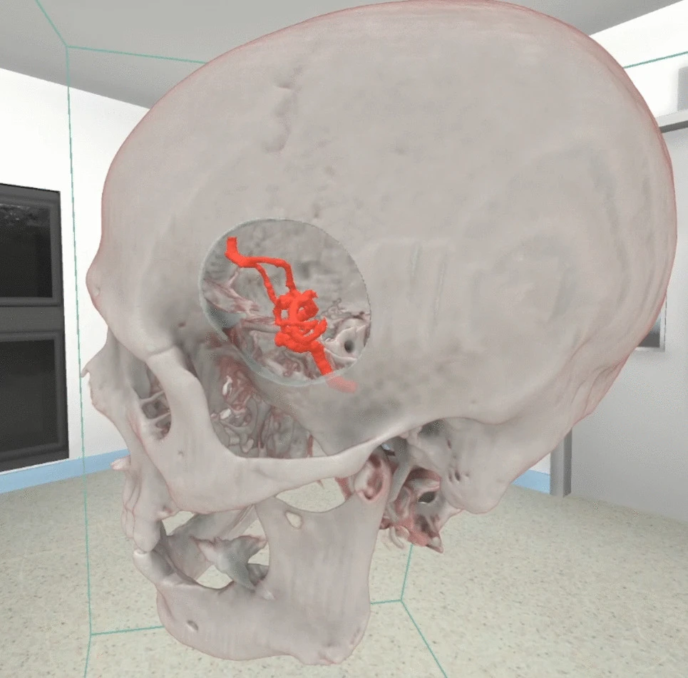 An image of a 3D model of a skull with an area marked for surgery