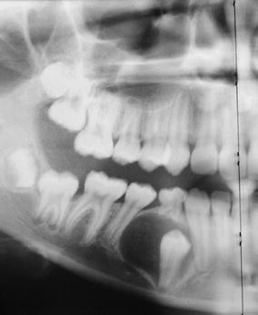 Adenomatoider Odontogener Tumor In Kalzifizierender Odontogener Zyste Springerlink