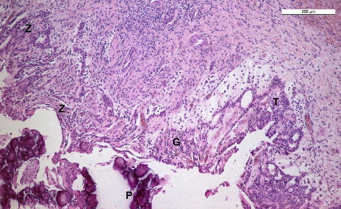 Adenomatoider Odontogener Tumor In Kalzifizierender Odontogener Zyste Springerlink