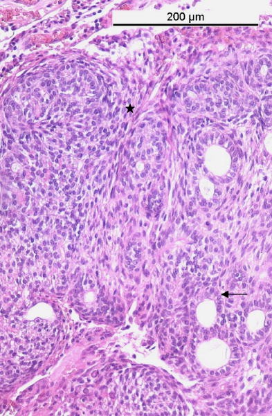Adenomatoider Odontogener Tumor In Kalzifizierender Odontogener Zyste Springerlink