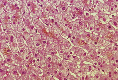 Homozygous Mutation Arg768trp In The Abc Transporter Encoding Gene Mrp2 Cmoat Abcc2 Causes Dubin Johnson Syndrome In A Caucasian Patient Journal Of Human Genetics Homozygous Mutation Arg768trp In The Abc Transporter Encoding Gene Mrp2 Cmoat Abcc2 Causes Dubin Johnson Syndrome In A Caucasian Patient Journal Of Human Genetics
