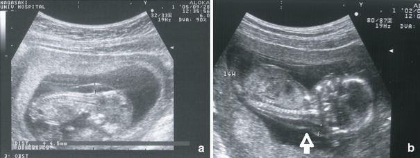 Thickness ultrasound nuchal Nuchal translucency