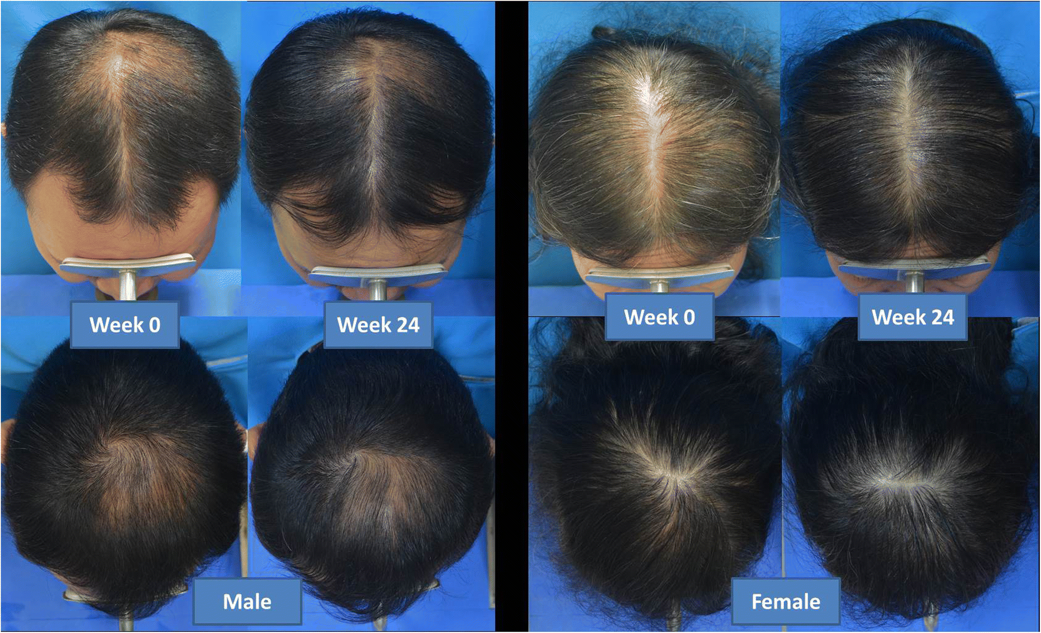 Low-level laser therapy for the treatment of androgenetic alopecia in Thai men and women: a 24-week, randomized, double-blind, sham device-controlled trial before and after