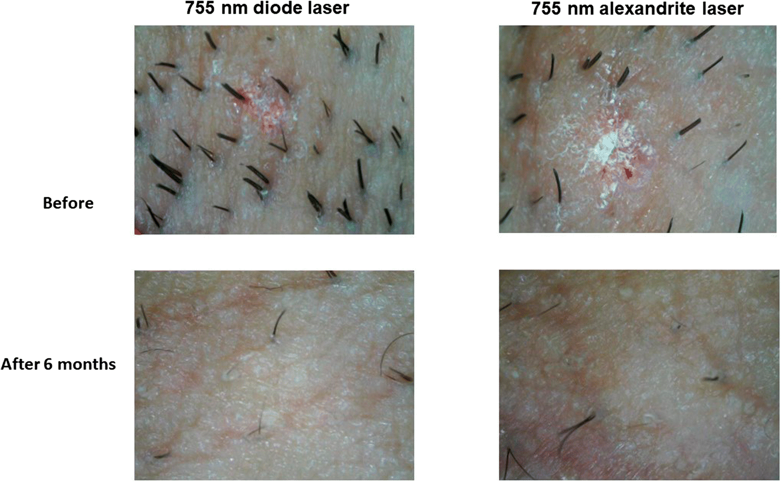 Figure 1 | Comparison of efficacy and safety of a novel 755-nm diode laser  with conventional 755-nm alexandrite laser in reduction of axillary hairs |  SpringerLink