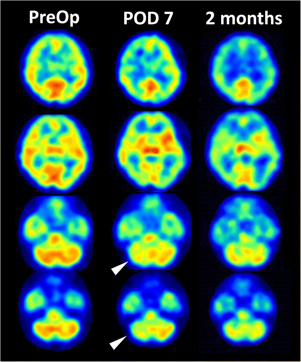 Figure 1 Crossed Cerebellar Diaschisis As An Indicator Of Severe Cerebral Hyperperfusion After Direct Bypass For Moyamoya Disease Springerlink