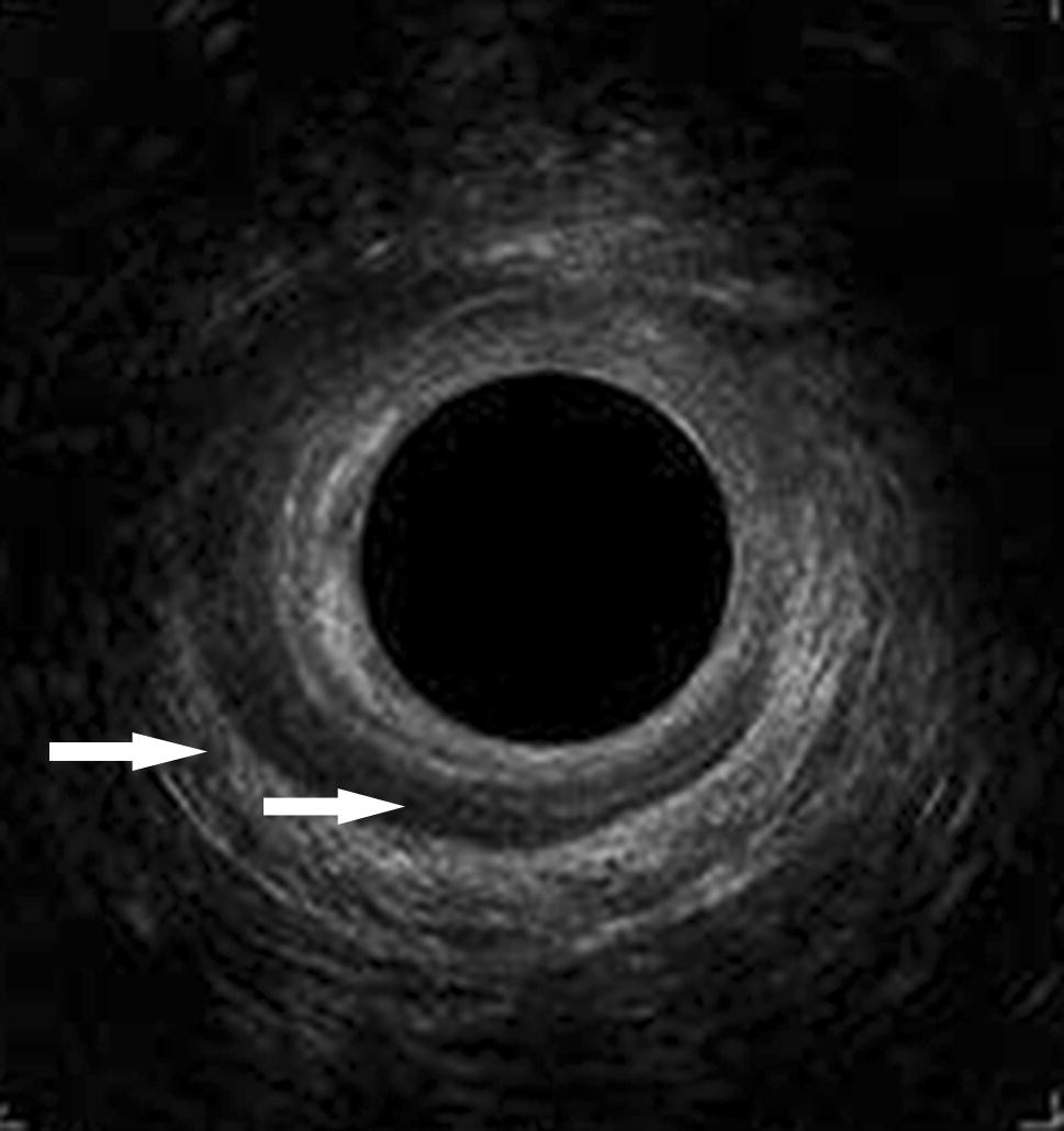 Figure 2 Long Term Outcome Of Sphincteroplasty With Separate Suturing Of The Internal And The External Anal Sphincter Springerlink Figure 2 Long Term Outcome Of Sphincteroplasty With Separate Suturing Of The Internal And The External Anal Sphincter Springerlink