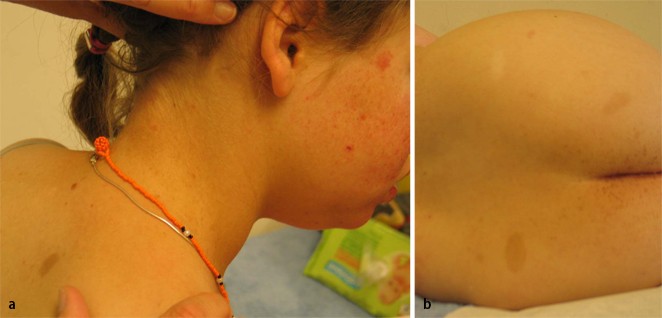 Figure 1 Tuberose Hirnsklerose Mit Gleichzeitiger Neurofibromatose Typ 1 Springerlink