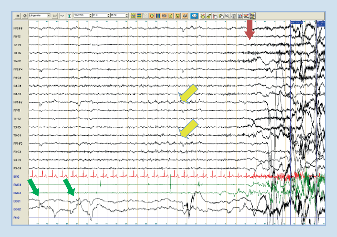 figure 2 epilepsie und parasomnien springerlink