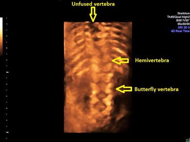 Download Figure 4 Prenatal Diagnosis Of Mediastinal Neurenteric Cyst A Case Report And Review Of The Literature Springerlink