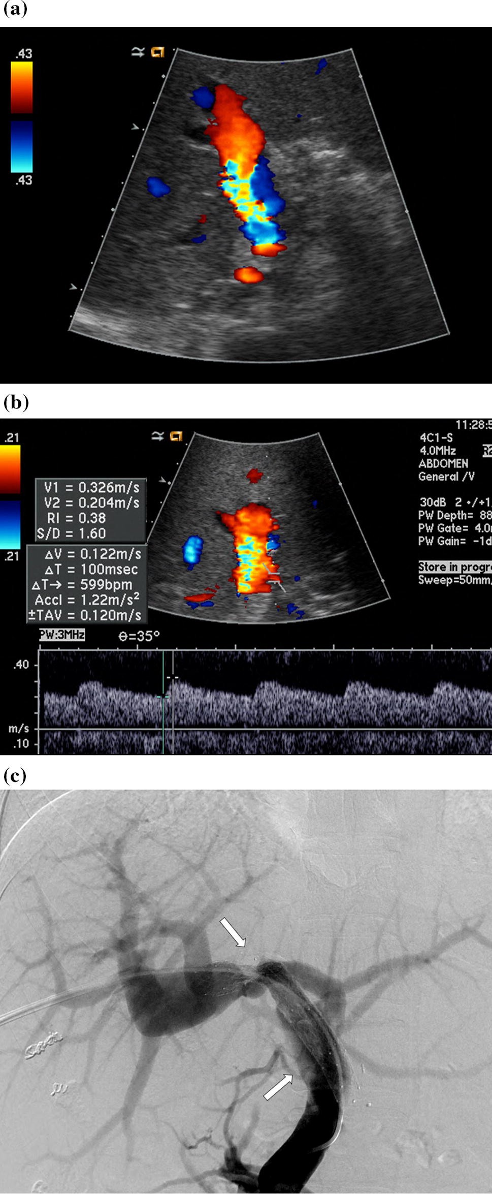 Figure 4 | Indirect Doppler ultrasound abnormalities of significant portal  vein stenosis after liver transplantation | SpringerLink