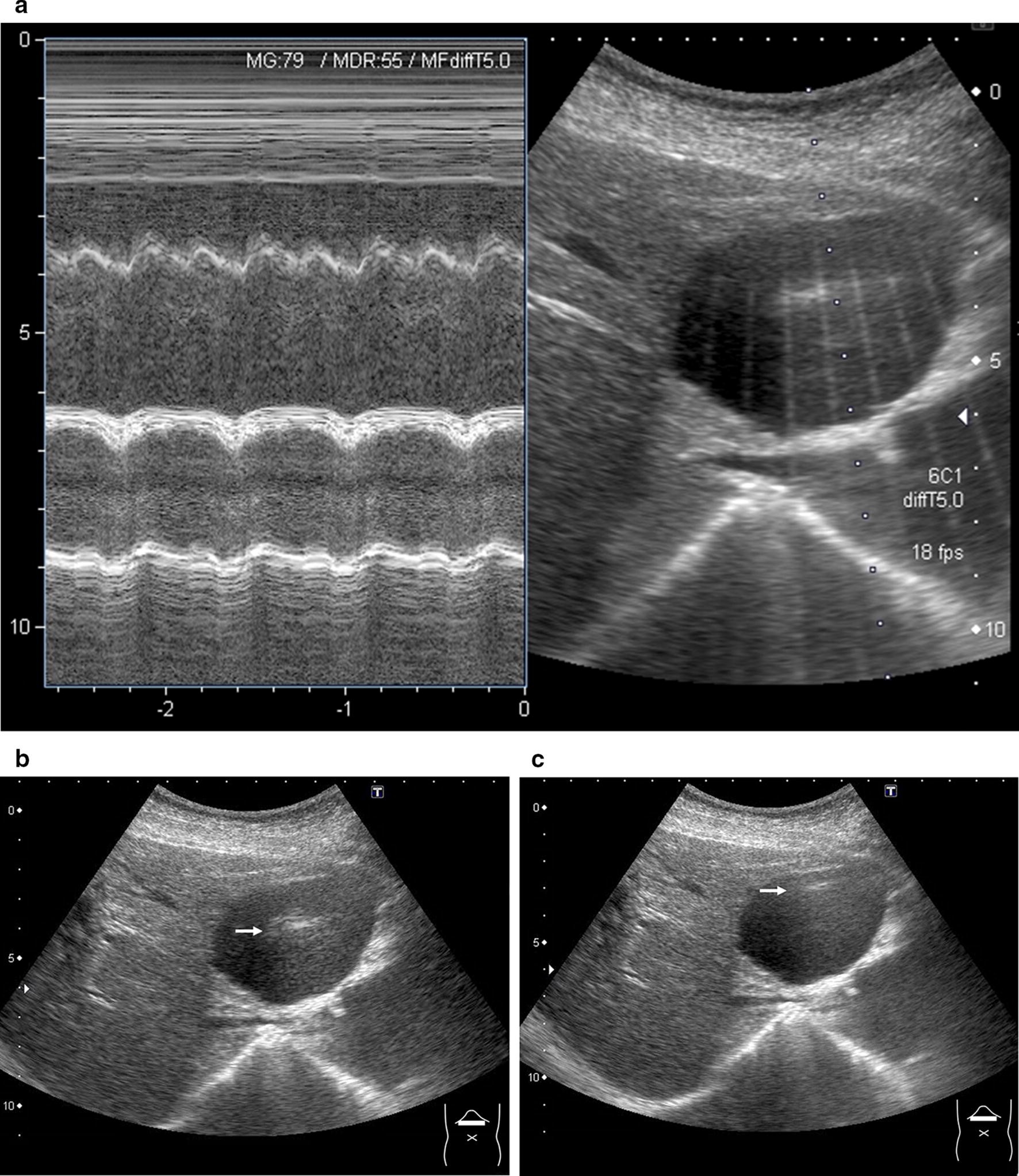 Figure 3 Range Ambiguity Artifact In Abdominal Ultrasound Springerlink
