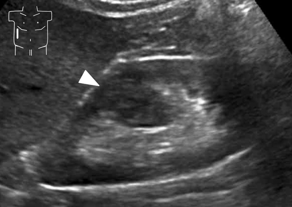 Figure 3 Common Pitfalls And Mistakes In Pediatric Ultrasound Springerlink