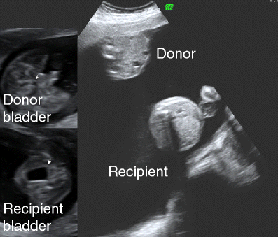 Figure 2 | Management of twin–twin transfusion syndrome | SpringerLink