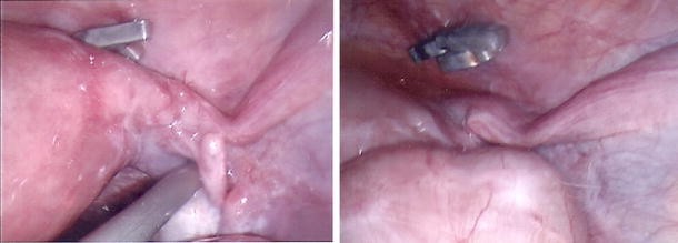 Tubal ectopic pregnancy on a patient with two previous consecutive laparosc...