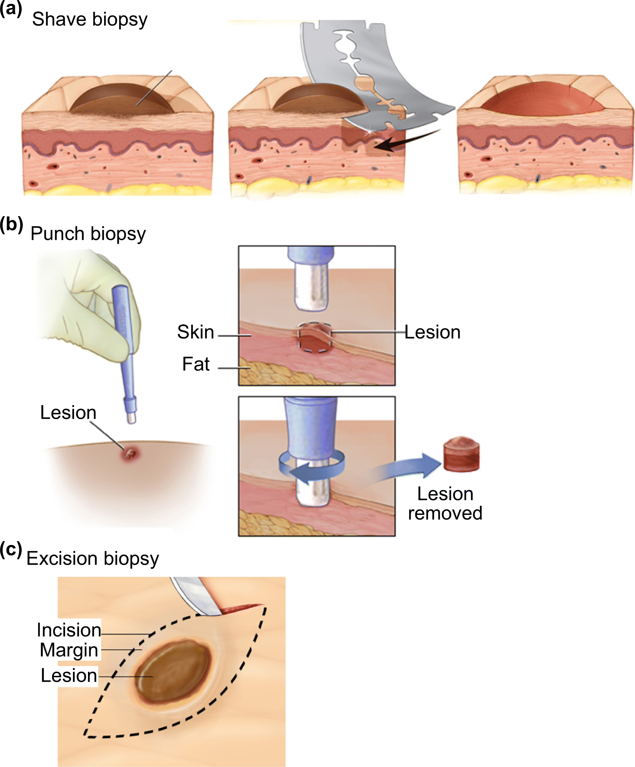 Featured image of post Steps to Prepare Punch Biopsy