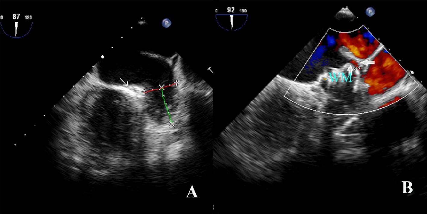 Figure 1 | Left atrial appendage orifice diameter measured with  trans-esophageal echocardiography is independently related with peri-device  leakage after Watchman device implantation | SpringerLink