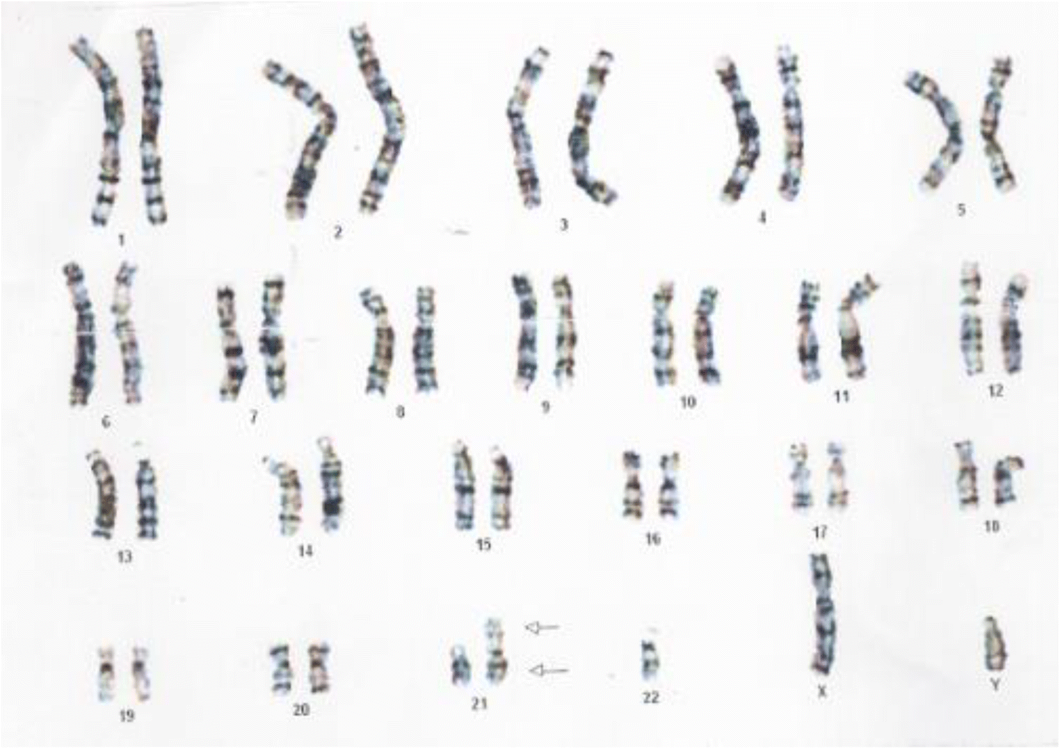 Figure 2 Chromosomal Segregation In Sperm Of The Robertsonian Translocation 21 22 Carrier And Its Impact On Ivf Outcome Springerlink