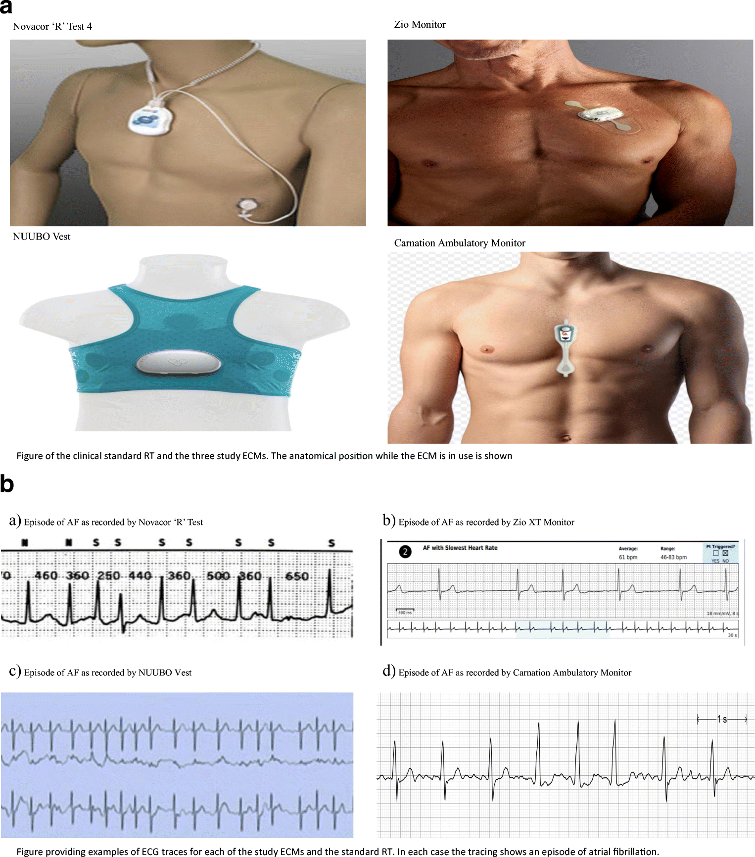 Figure 1 | A randomized trial evaluating the accuracy of AF detection by  four external ambulatory ECG monitors compared to permanent pacemaker AF  detection | SpringerLink