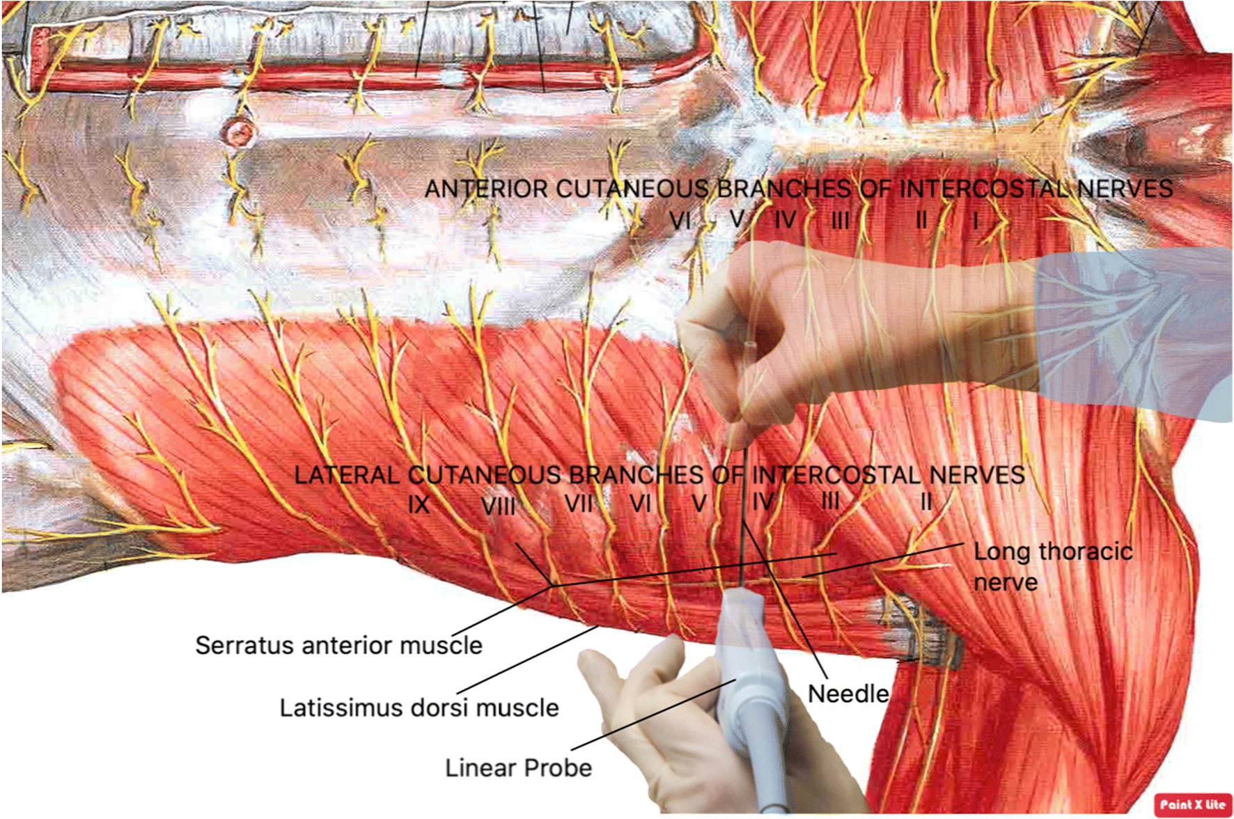 Figure 1 | Ultrasound-guided serratus anterior plane block for subcutaneous  implantable cardioverter defibrillator implantation using the intermuscular  two-incision technique | SpringerLink