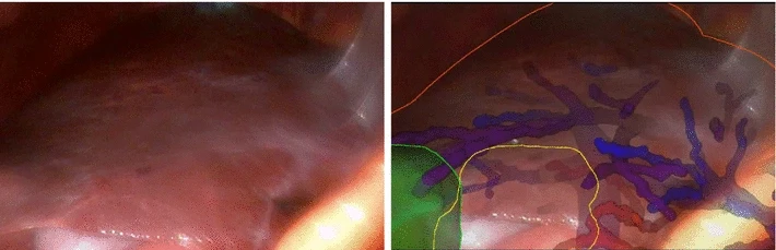 SmartLiver overlay.