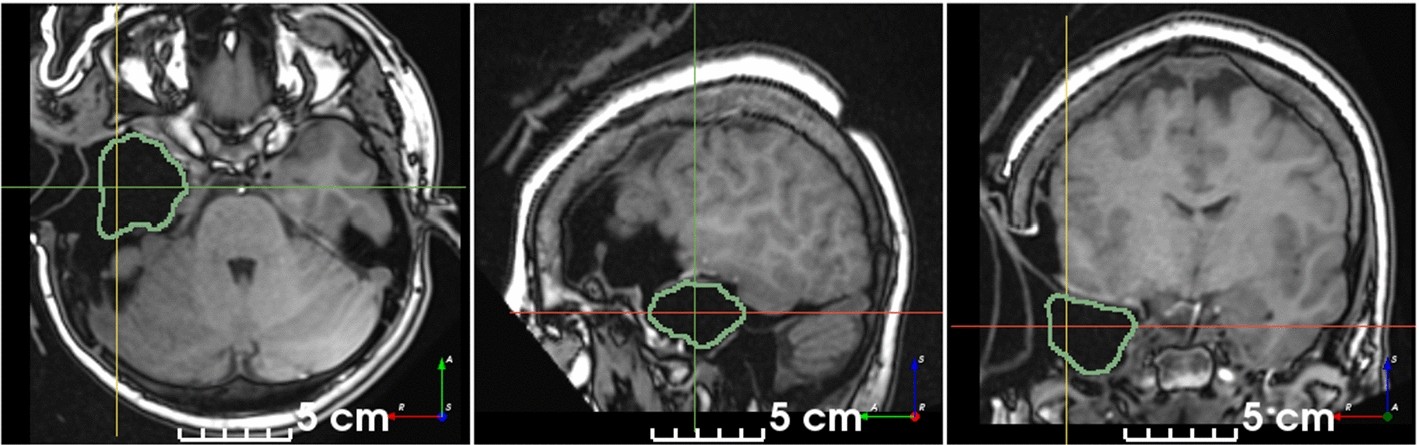 Segmentation of intraoperative
MRI