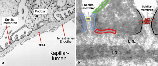 Figure 1 Nephrotisches Syndrom Springerlink