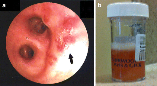 Figure 1 Pseudohemoptysis Due To Serratia Marcescens Springerlink