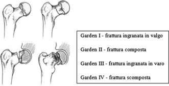 Figure 2 L Utilizzo Della Protesi D Anca Nel Trattamento Delle Fratture Del Femore Prossimale Springerlink