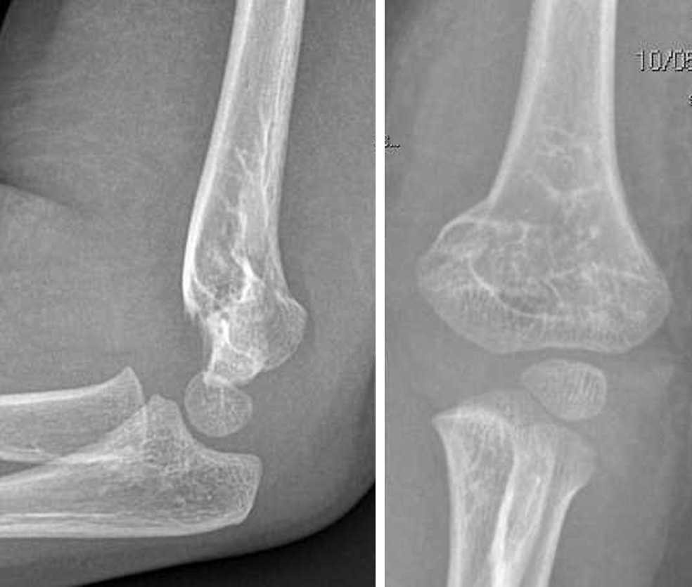 Figure 1 Le Fratture Sovracondiloidee Dell Omero In Eta Pediatrica Springerlink