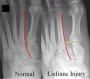 Figure 3 Le Fratture Lussazioni Della Lisfranc Springerlink