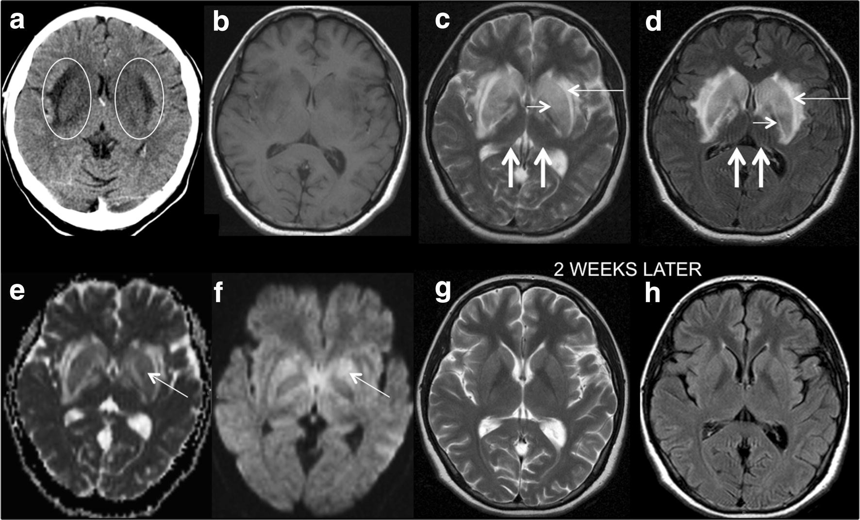 Figure 1 | Central PRES (posterior reversible encephalopathy syndrome) in  HELLP syndrome | SpringerLink