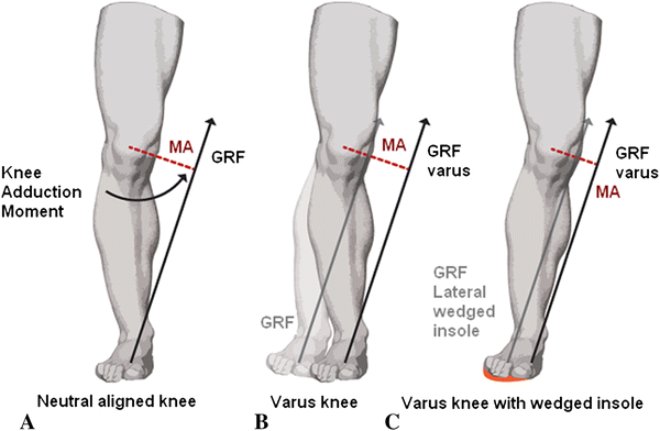 lateral wedge insoles for medial knee osteoarthritis