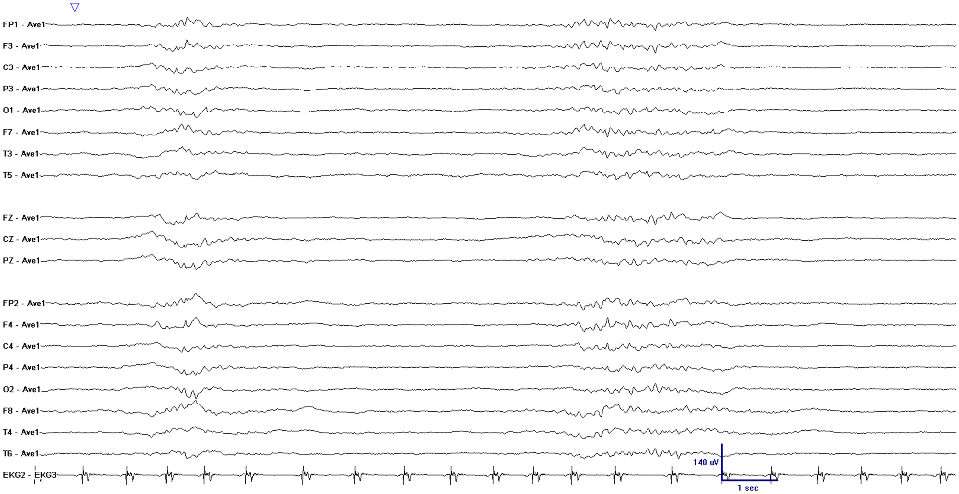 burst suppression eeg burst suppression eeg